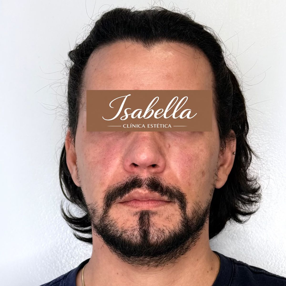 Corrección de Ojeras