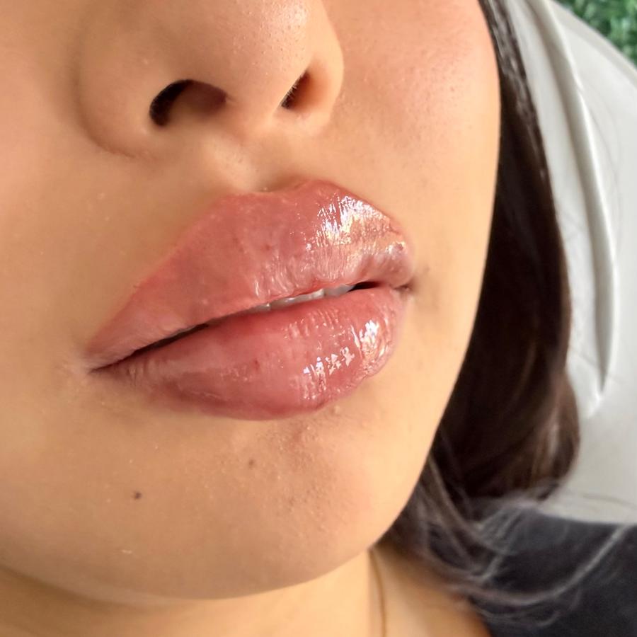 Aumento de <em>Labios</em>