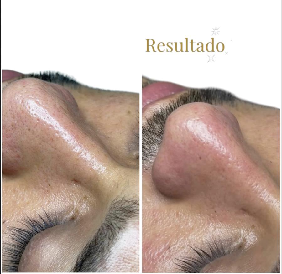 Limpieza facial profunda