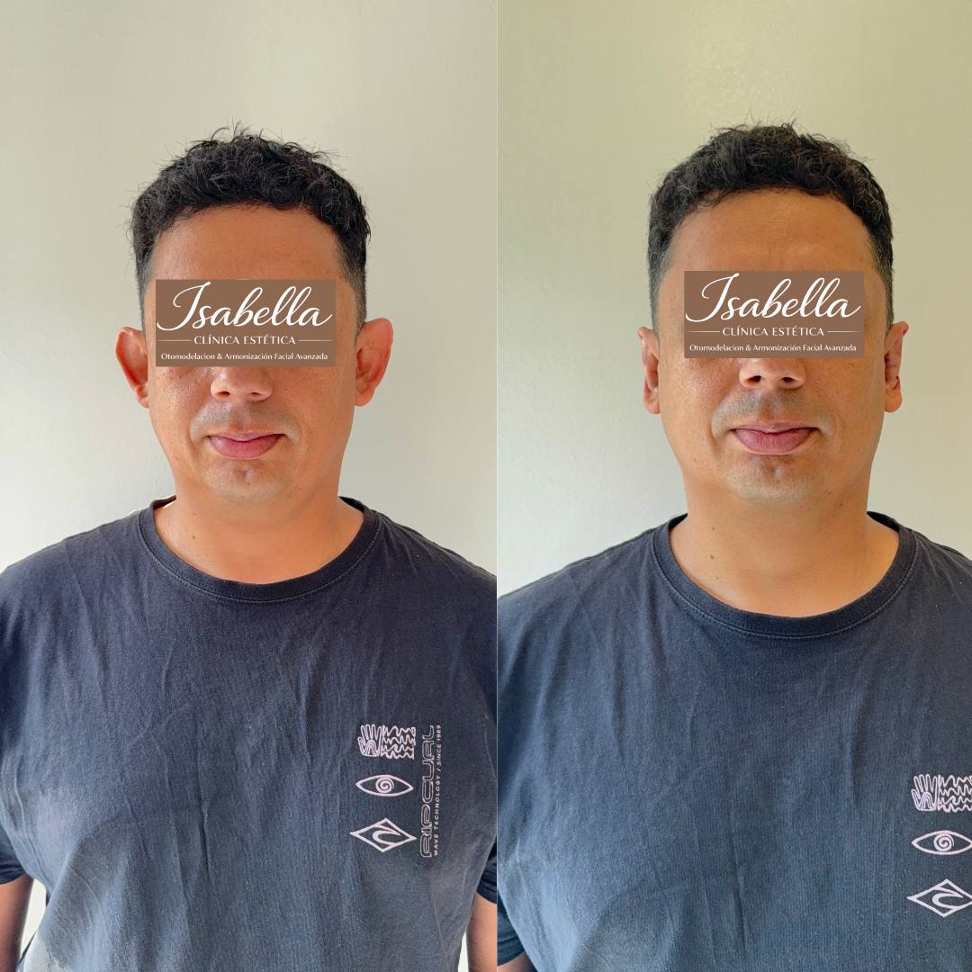 Otomodelación Definitiva antes y después - caso 2