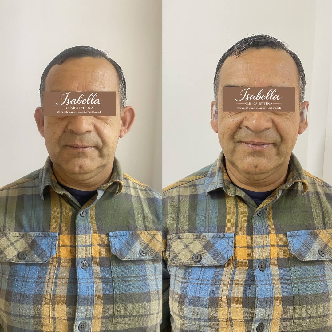 Otomodelación Definitiva antes y después - caso 5