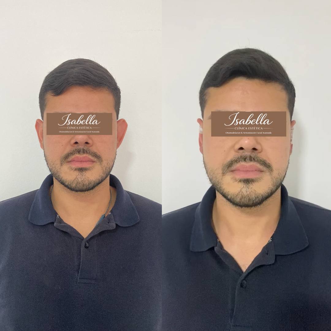 Otomodelación Definitiva antes y después - caso 6