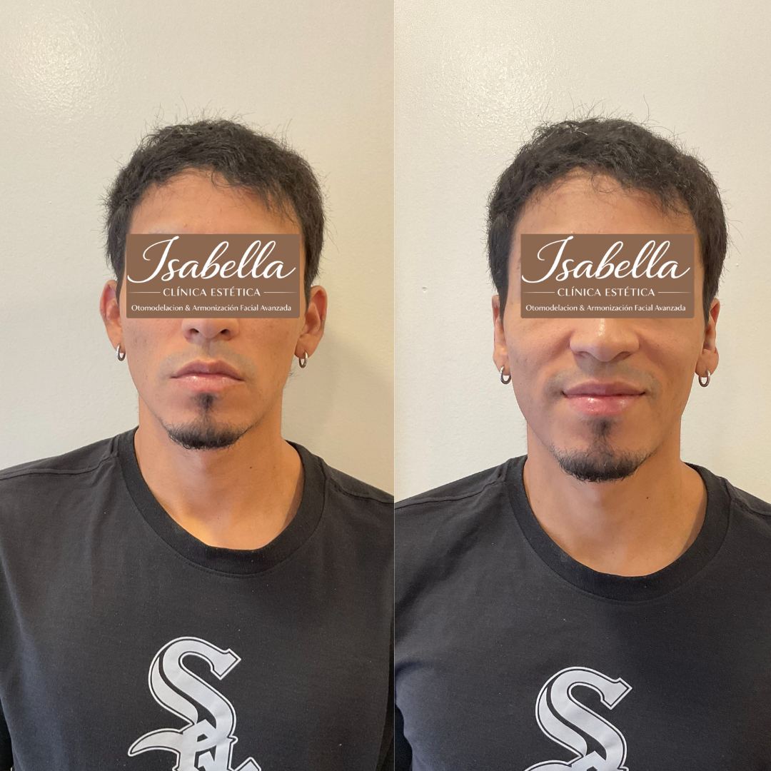 Otomodelación Definitiva antes y después - caso 8