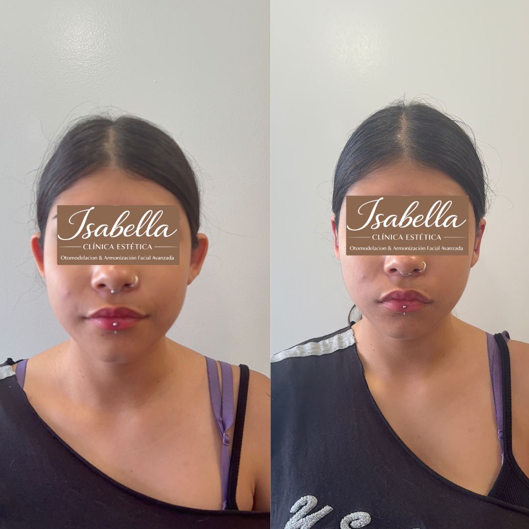 Otomodelación Definitiva antes y después - caso 12