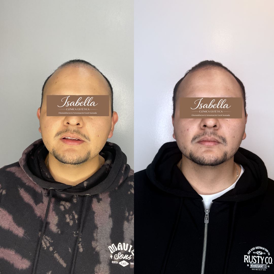 Otomodelación Definitiva antes y después - caso 14