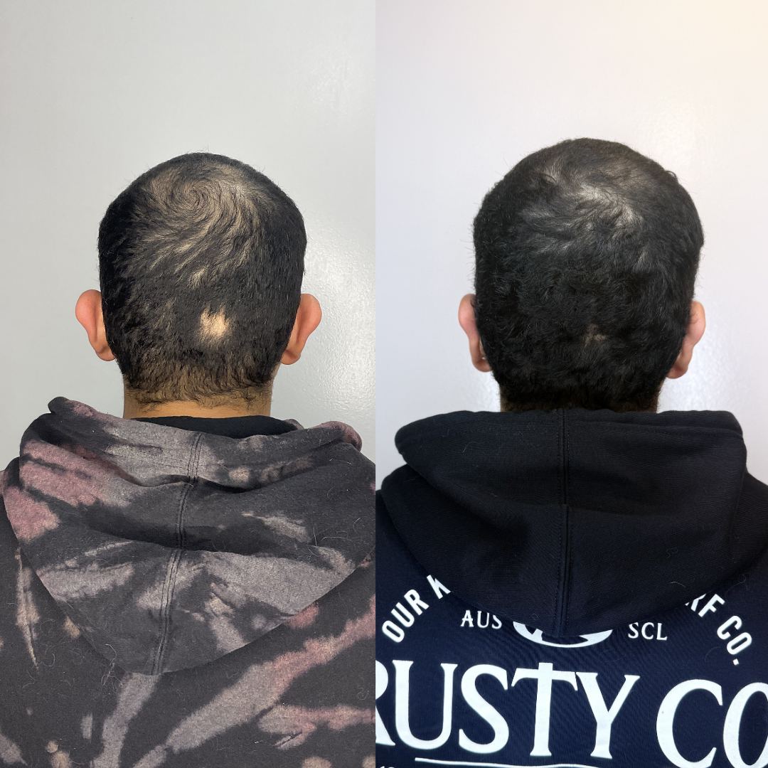 Otomodelación Definitiva antes y después - caso 15