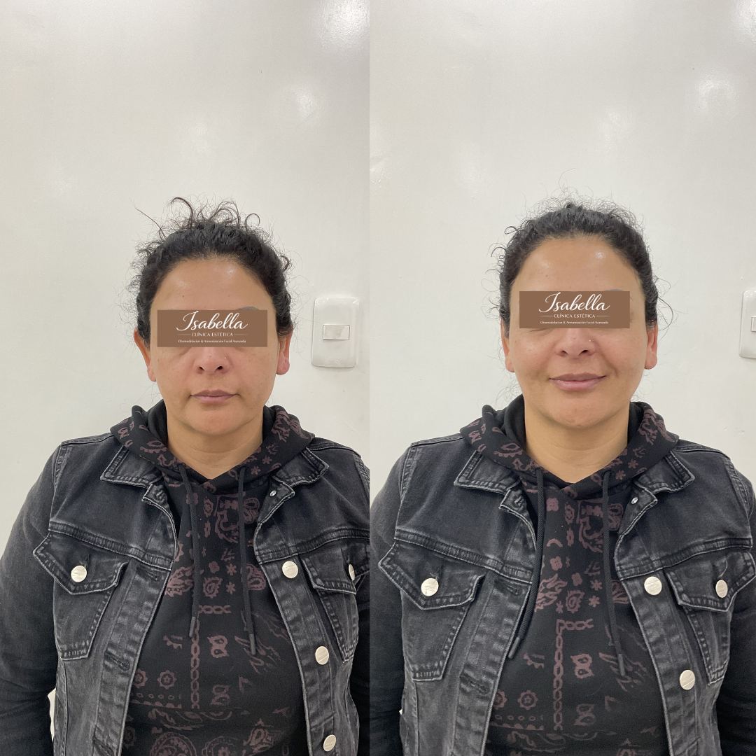 Otomodelación Definitiva antes y después - caso 19