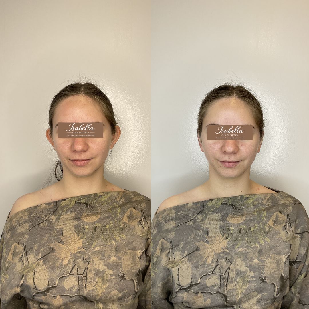 Otomodelación Definitiva antes y después - caso 20