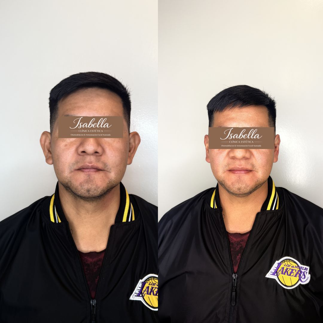 Otomodelación Definitiva antes y después - caso 22
