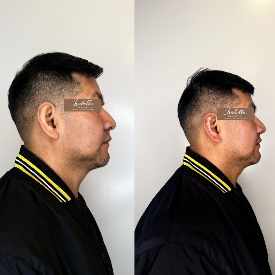 Otomodelación Definitiva antes y después - caso 23
