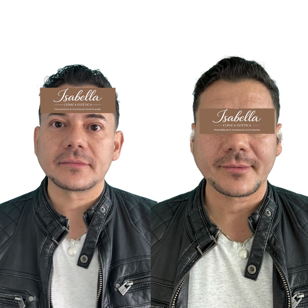 Otomodelación Definitiva antes y después - caso 26