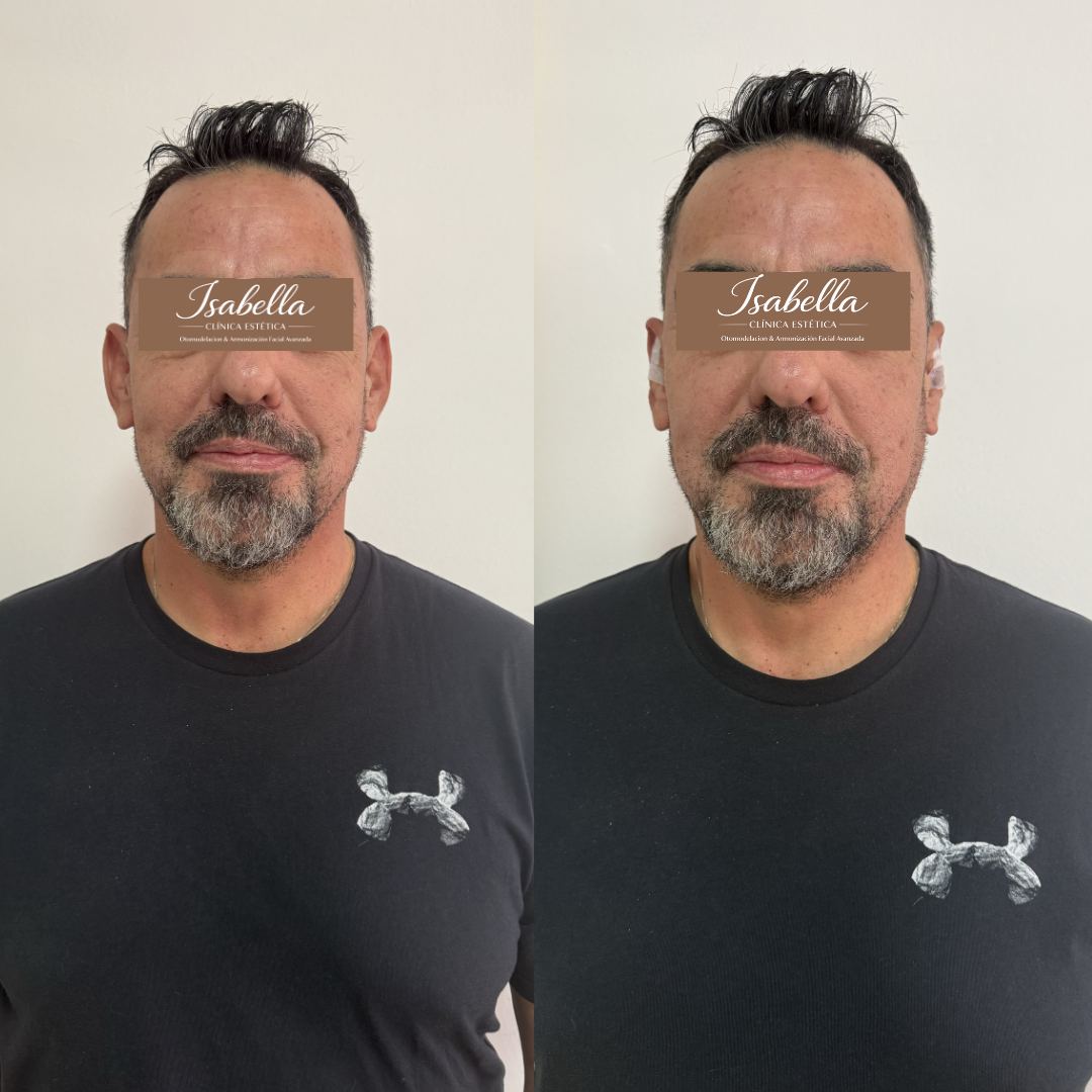 Otomodelación Definitiva antes y después - caso 27
