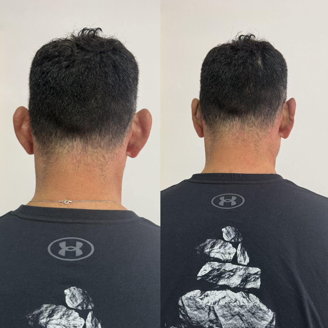 Otomodelación Definitiva antes y después - caso 28