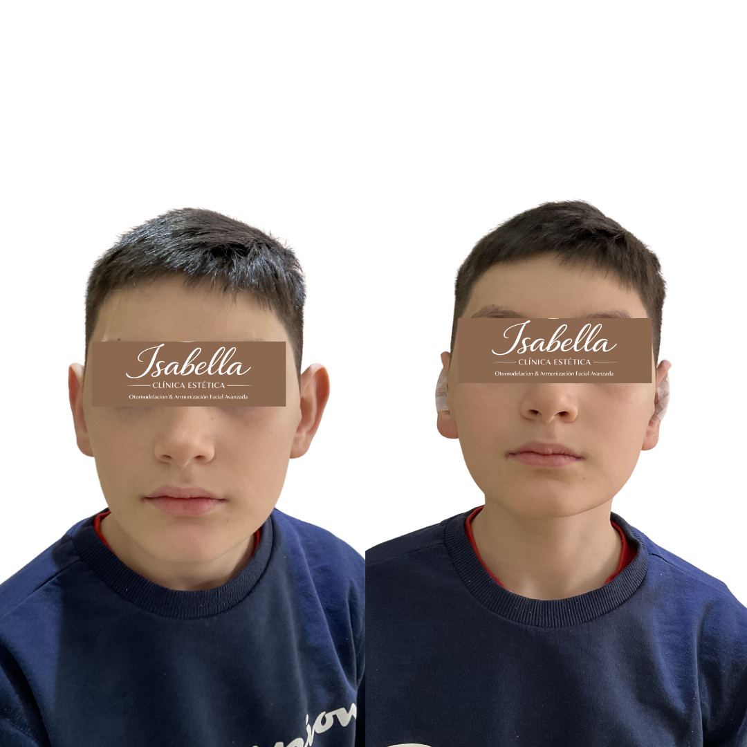 Otomodelación Definitiva antes y después - caso 29