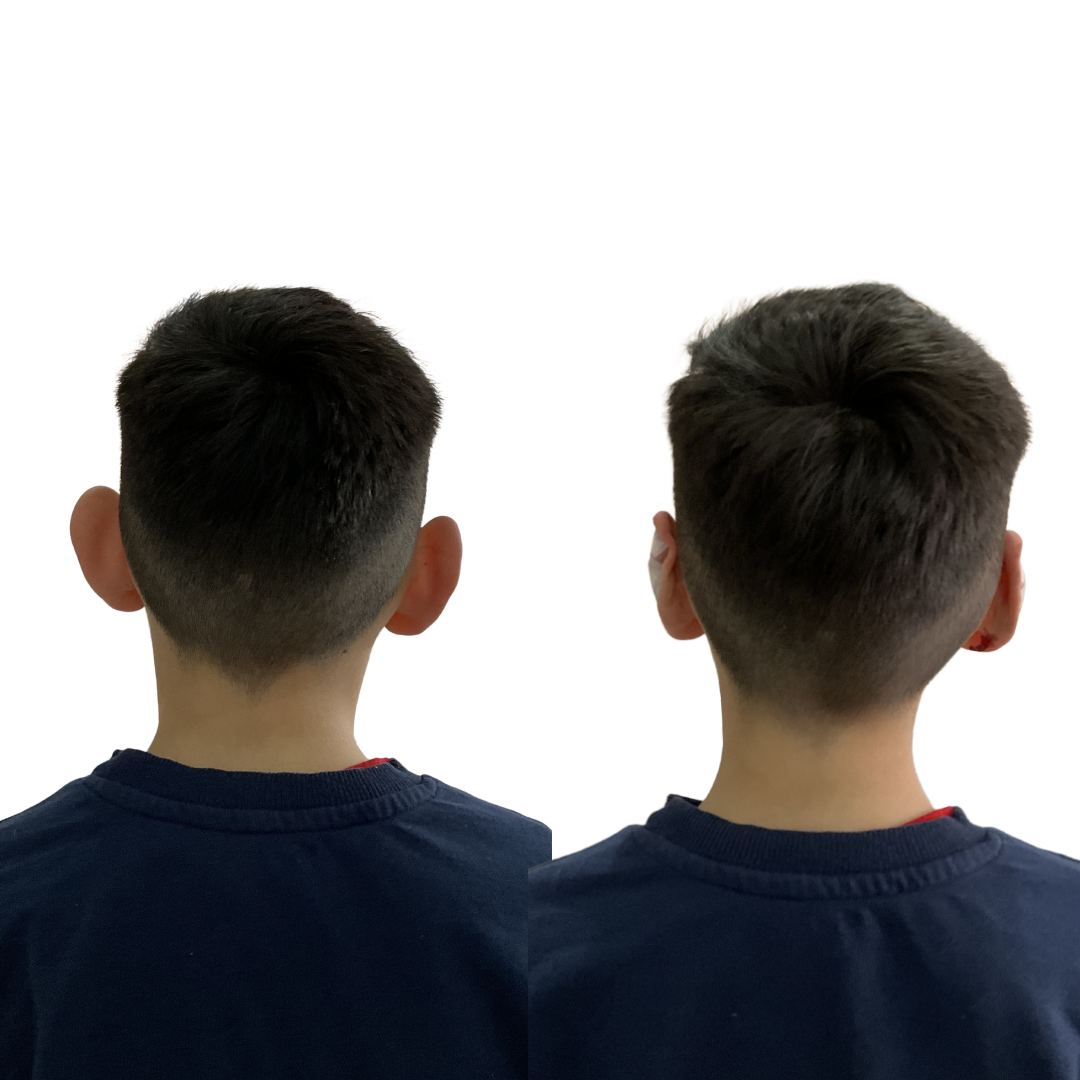 Otomodelación Definitiva antes y después - caso 30