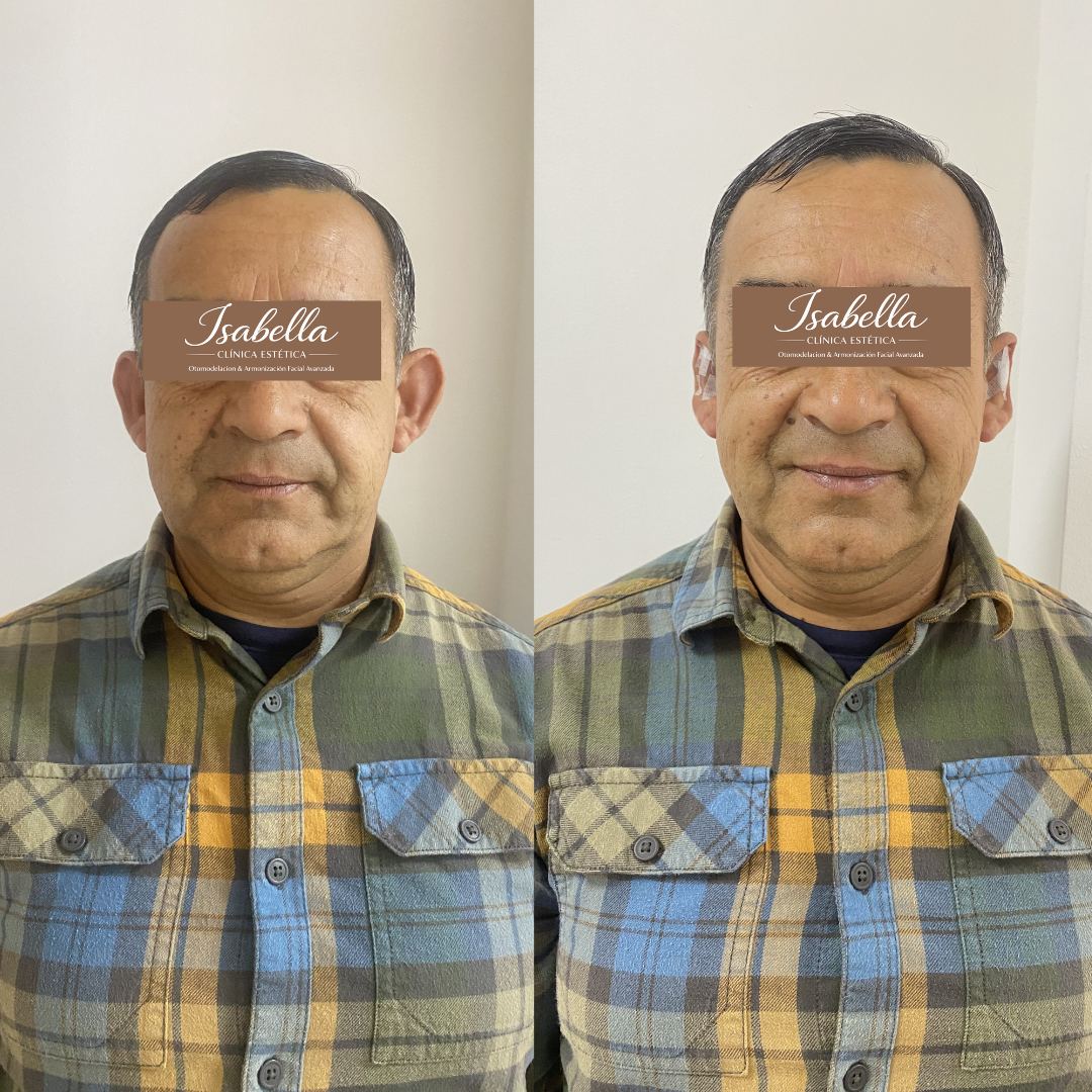 Otomodelación Definitiva antes y después - caso 31