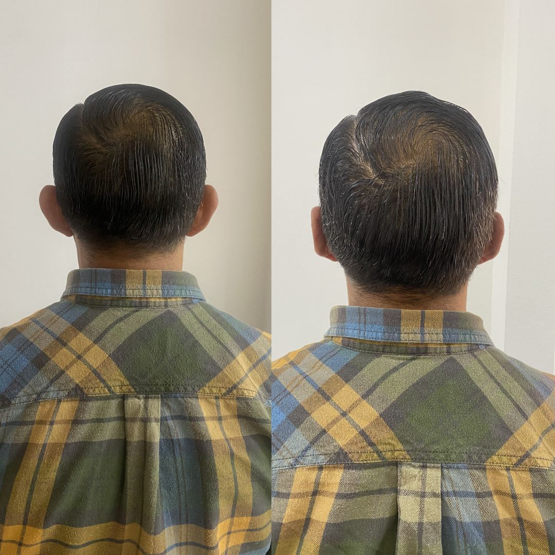 Otomodelación Definitiva antes y después - caso 32