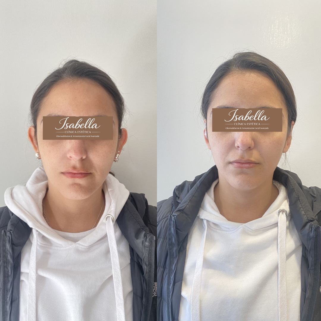 Otomodelación Definitiva antes y después - caso 33