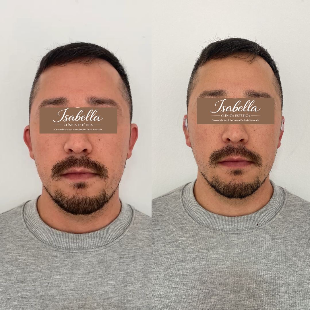 Otomodelación Definitiva antes y después - caso 34