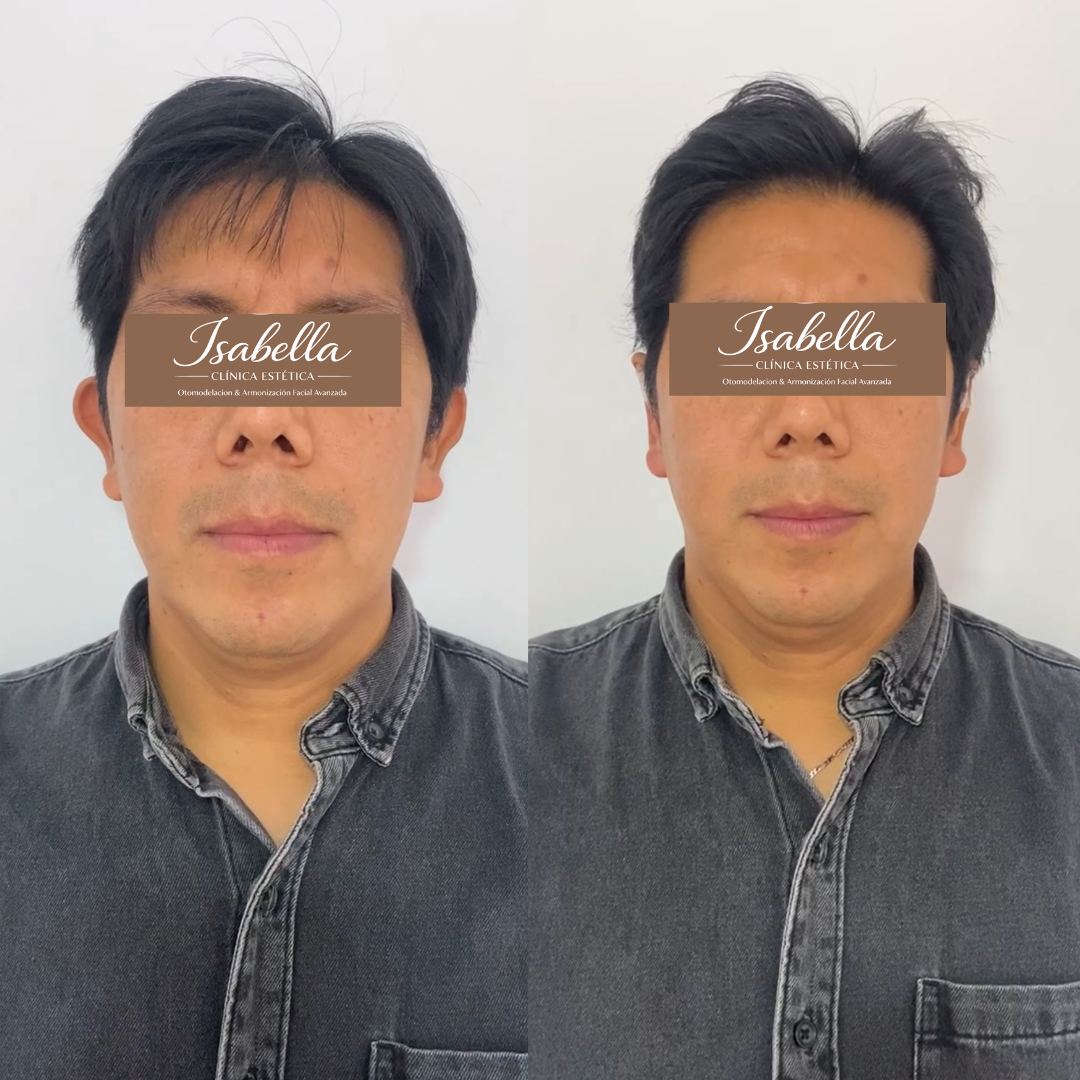 Otomodelación Definitiva antes y después - caso 36