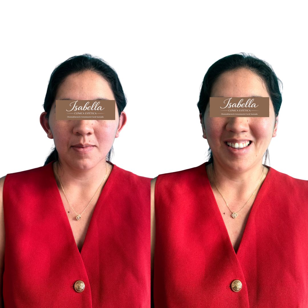 Otomodelación Definitiva antes y después - caso 38