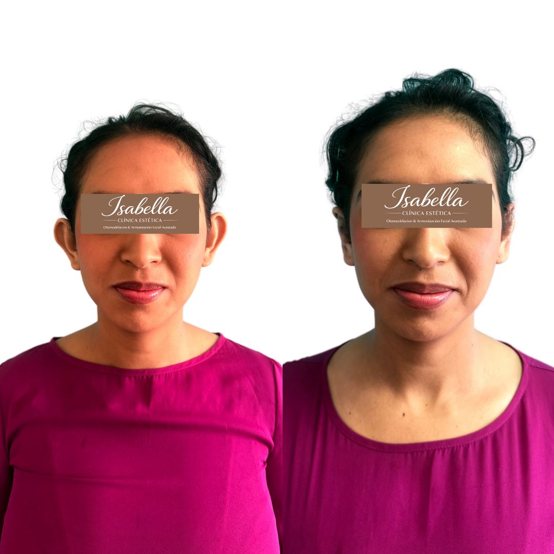 Otomodelación Definitiva antes y después - caso 40