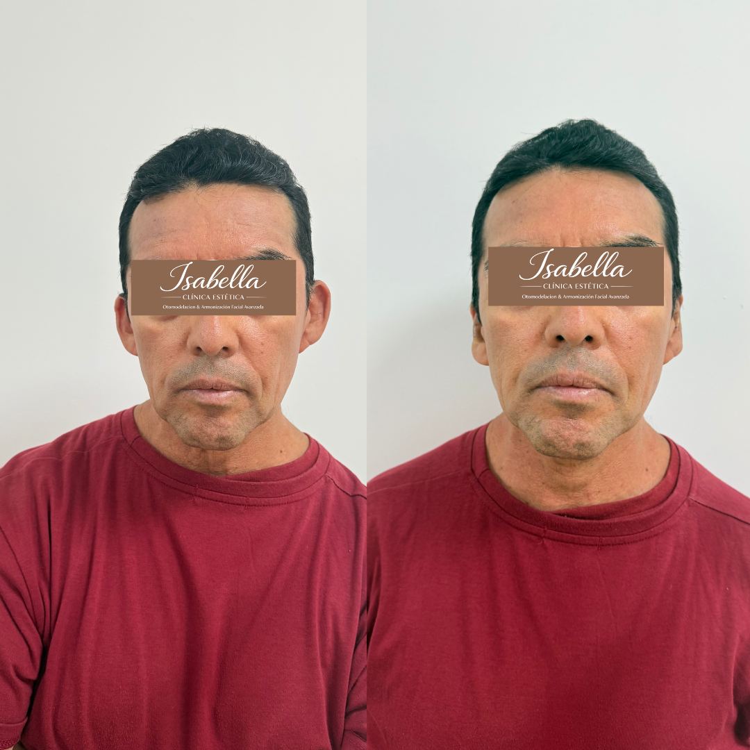 Otomodelación Definitiva antes y después - caso 41