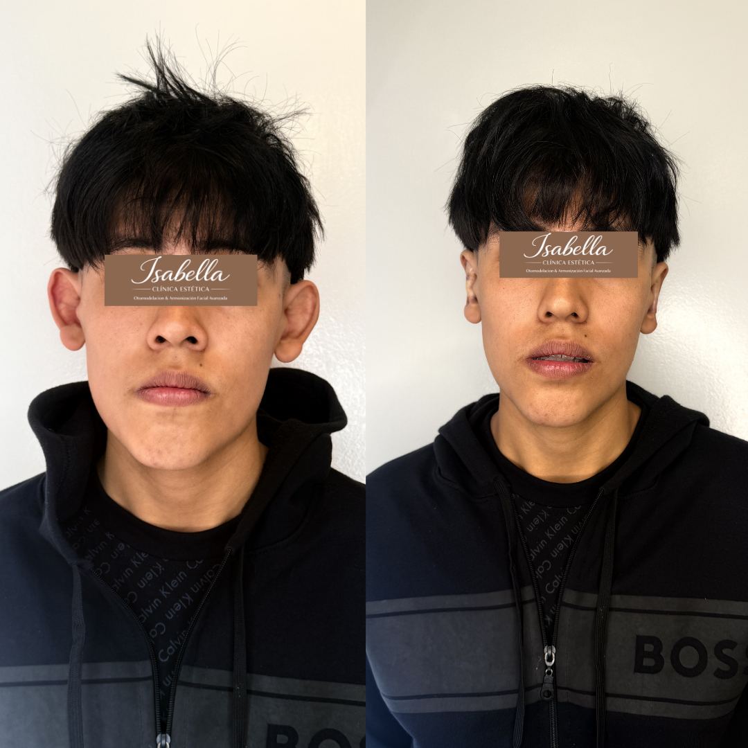 Otomodelación Definitiva antes y después - caso 42
