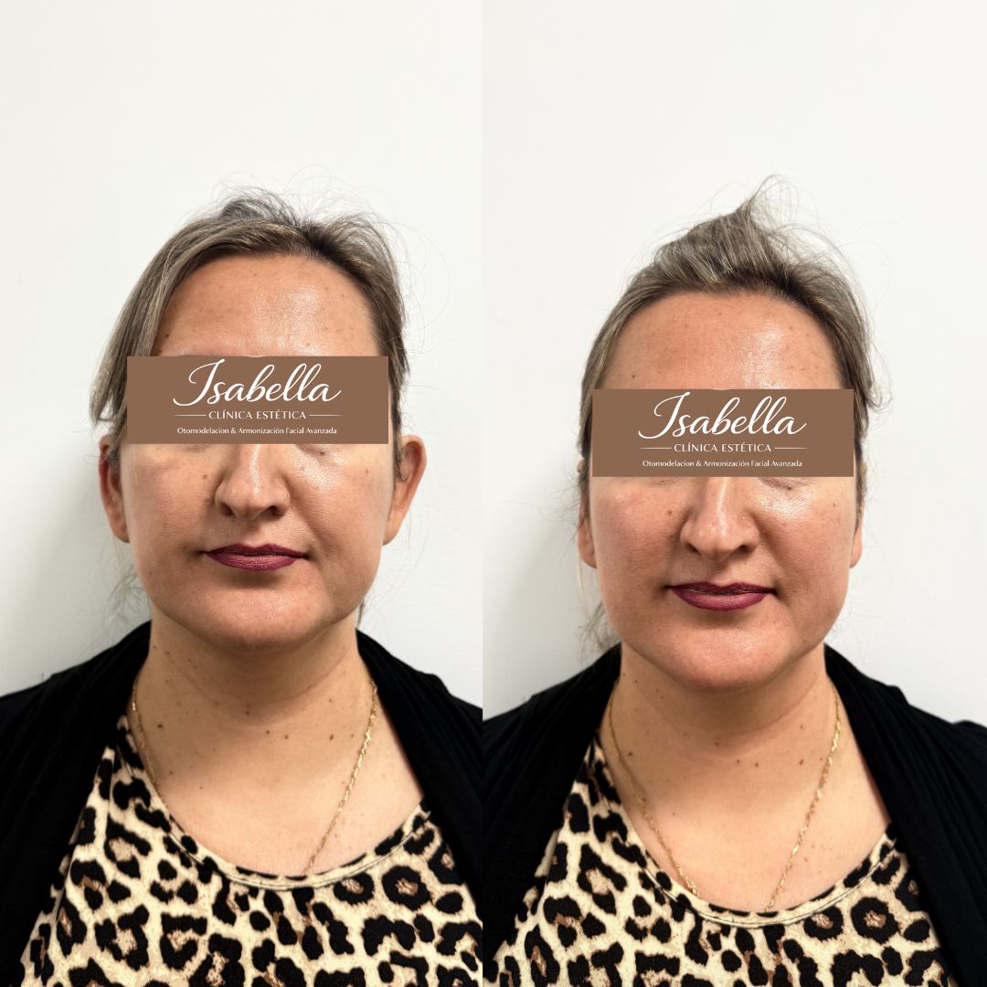 Otomodelación Definitiva antes y después - caso 44