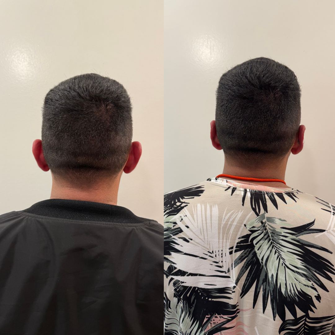Otomodelación Definitiva antes y después - caso 45