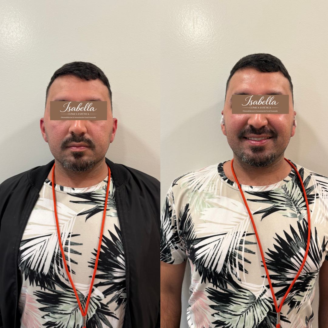 Otomodelación Definitiva antes y después - caso 46