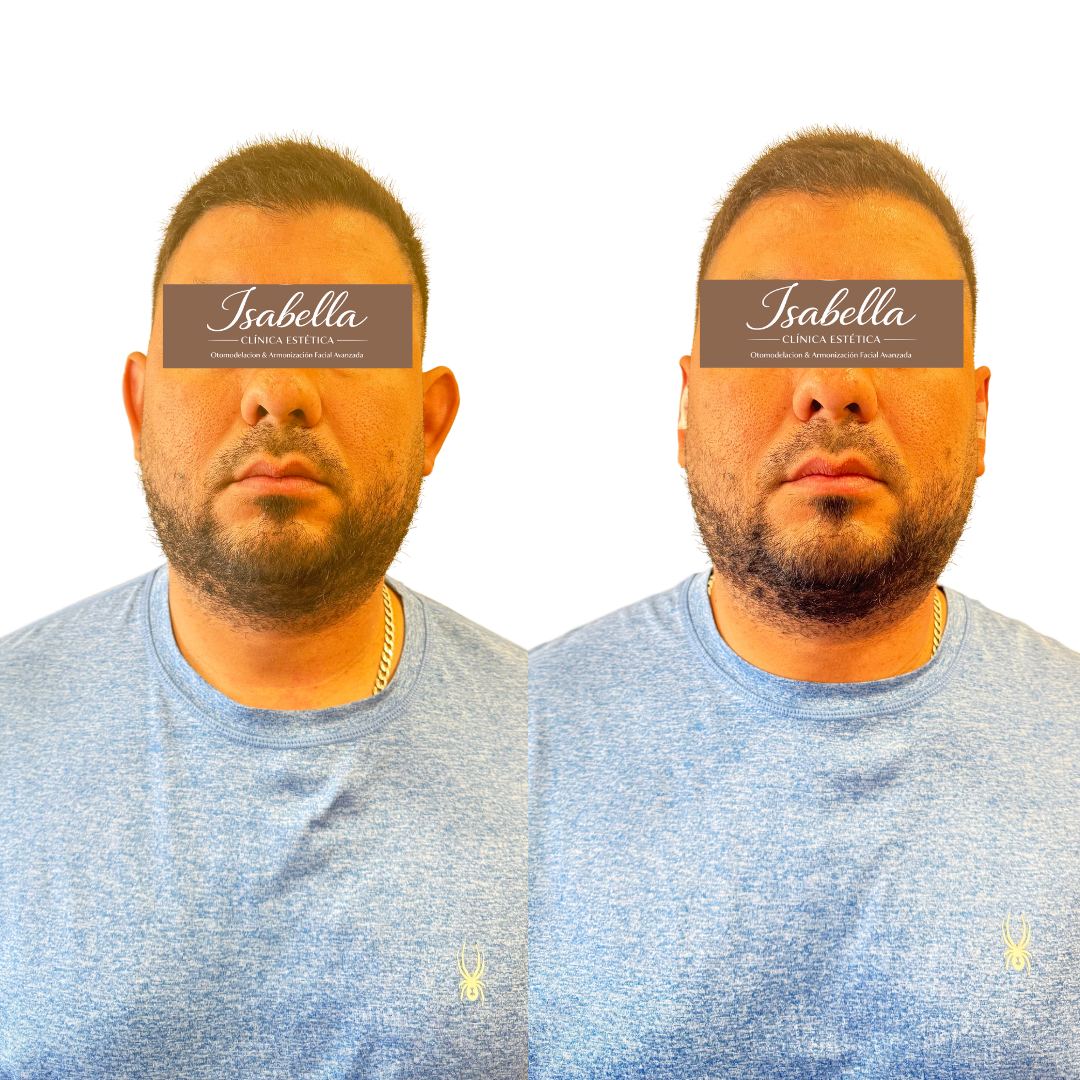 Otomodelación Definitiva antes y después - caso 49