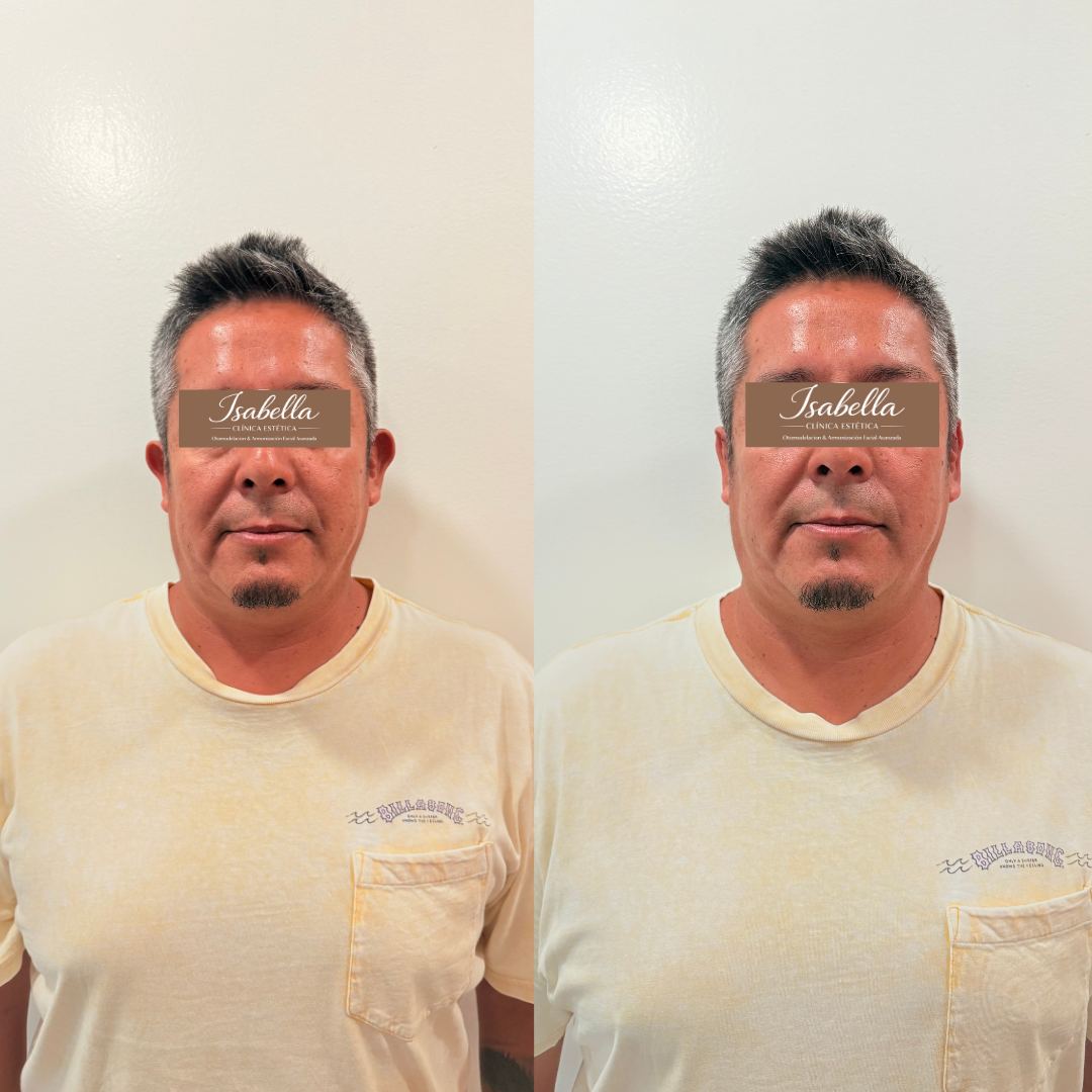Otomodelación Definitiva antes y después - caso 50