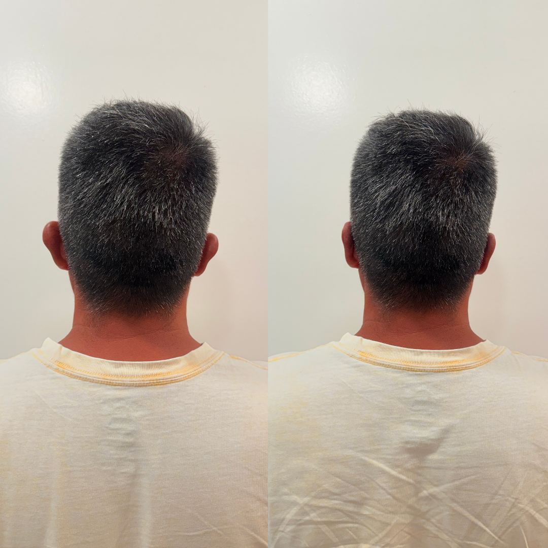 Otomodelación Definitiva antes y después - caso 51