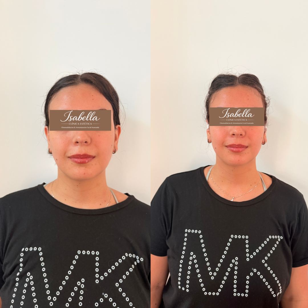 Otomodelación Definitiva antes y después - caso 52
