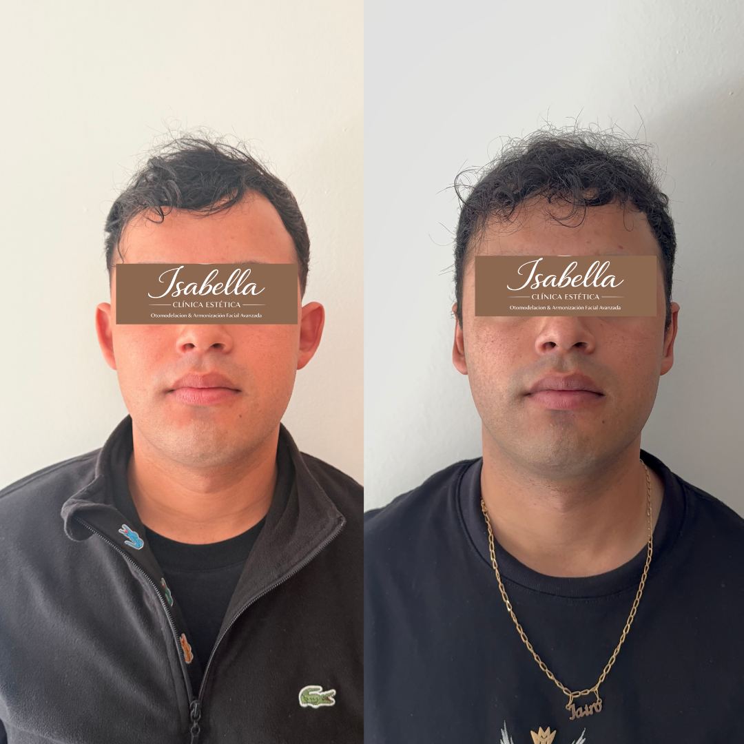 Otomodelación Definitiva antes y después - caso 53