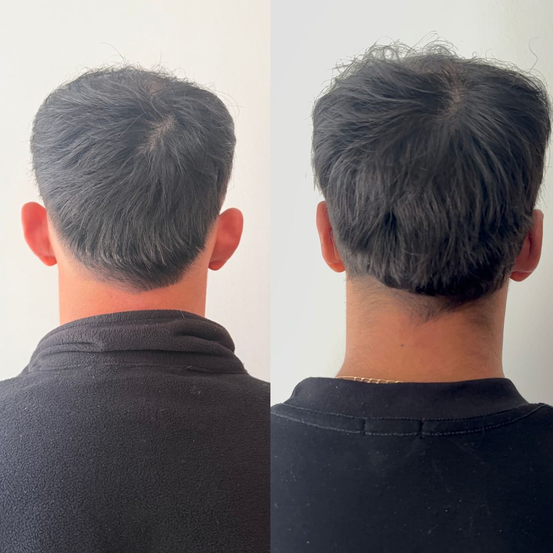 Otomodelación Definitiva antes y después - caso 54