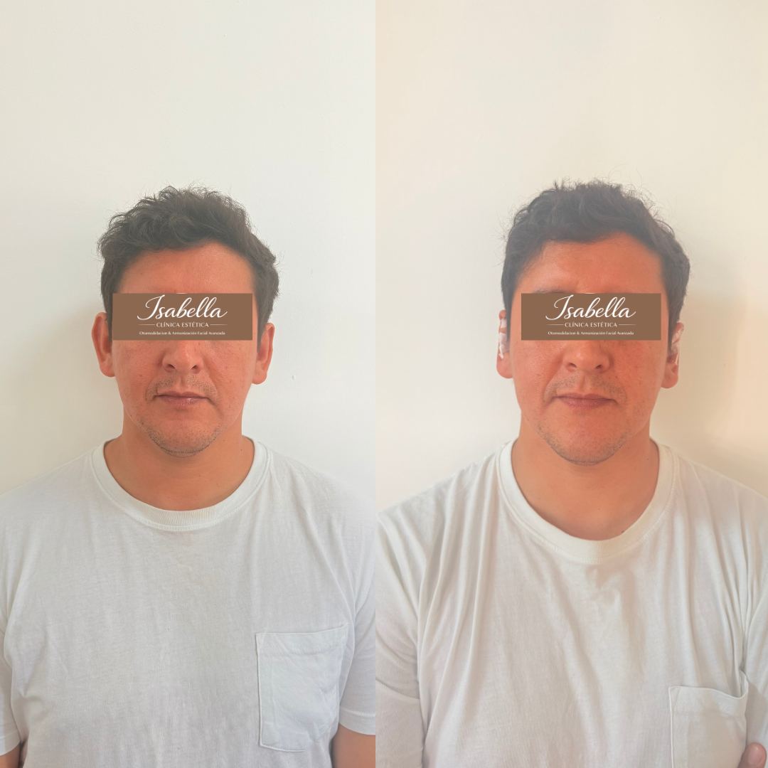 Otomodelación Definitiva antes y después - caso 56